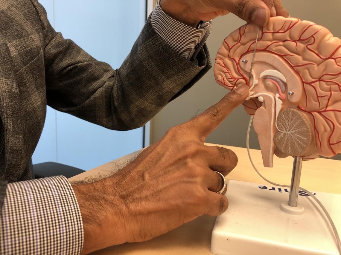 The stimulation device is placed in the subcallosal cingulate, an area of the brain believed to play an important role in depression.