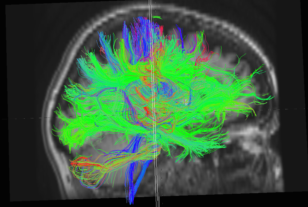 DTI Brain Scan
