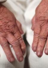 Patient with their hands resting on their knees.